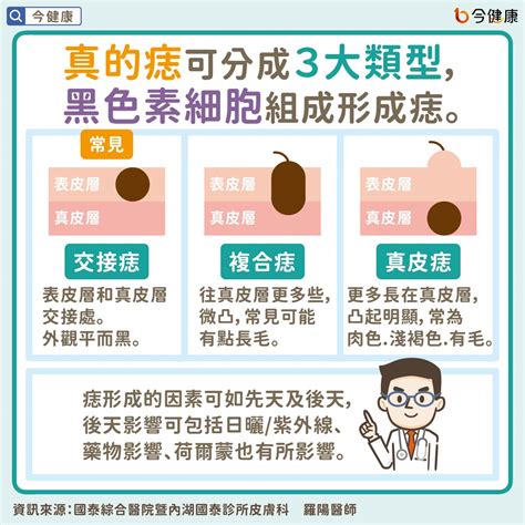 臉上為什麼會長痣|是痣？還是皮膚癌？皮膚科醫師教你揪出「假的痣」，。